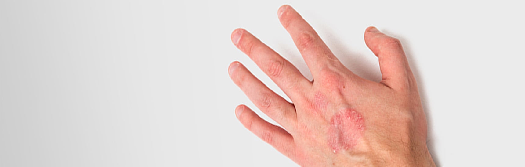 psoriasis pustulosa leve